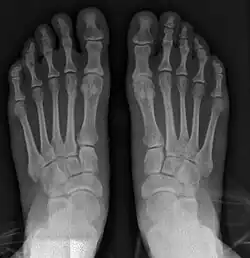 2_years_after_syndesmosis_surgery