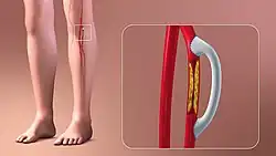 3D Medical Animation still shot depicting the Vascular Bypass Grafting