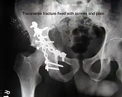 Transverse fracture fixed with screws and plate