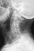 Block vertebrae of the cervical spine (vertebrae 4 and 5). Probably based on degenerative or inflammatory changes.
