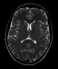 Normal axial T2-weighted MR image of the brain