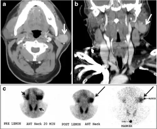 Fig. 17. Ectopic thyroid on the left parotid gland with a palpable left parotid mass in a 69-year-old male patient. a, b Axial and coronal enhanced neck CT scan demonstrates well-defined homogeneous enhancing mass (white arrows) within the left parotid gland with preserved surrounding fat planes. It also shows a normal thyroid in normal position in the lower neck. c Image taken 20 minutes after 5 mCi injected Tc99m-Pertechnetate shows normal thyroid uptake of tracer and physiological uptake in the salivary glands (short black arrow). There is a distinct focus of abnormal tracer accumulation in the left parotid/submandibular region. Patient was given lemon juice with evident normal washout from the salivary glands and relative retention by this abnormal focus (long black arrow).[1]