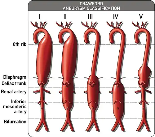 The Crawford Classification (Extent I-IV) and the Safi modification (Extent V) for thoracoabdominal aortic aneurysms is pictured above.