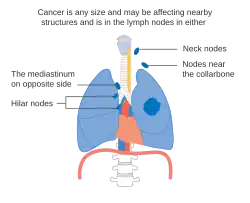 Stage IIIB lung cancer