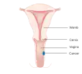 Stage 1 vaginal cancer