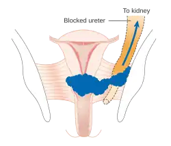 Stage 3B cervical cancer