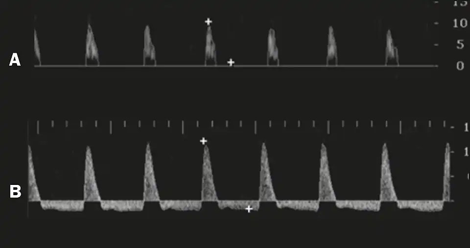 Graphs representing the color Doppler spectrum of the flow pattern of the cavernous arteries during the erection phases. A: Single-phase flow with minimal or absent diastole when the penis is flaccid. B: Increased systolic flow and reverse diastole 25 min after injection of prostaglandin.[48]
