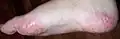 Advanced stage of dyshidrosis on the foot