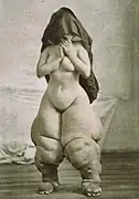 A striking example of objectification. Published as Bellevue Venus by Oscar G. Mason, for depicting elephantiasis.