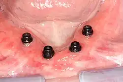 Four mandibular implants