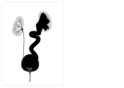 High grade vesico-ureteric reflux - easily mistaken for cystic renal disease on early scans