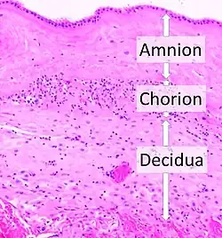 Acute choriodeciduitis, with neutrophils seen in the chorion and decidua.