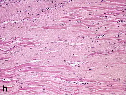 Replacement fibrosis in myocardial infarction, being boundless and dense.