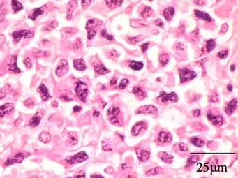 Extranodal NK/T cell lymphoma, nasal type.[105] It may be incidentally discovered in people undergoing surgery for sinusitis.[106]