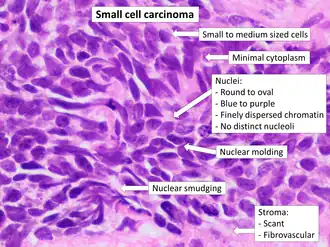 Histopathology of small-cell carcinoma, with typical findings.[130]