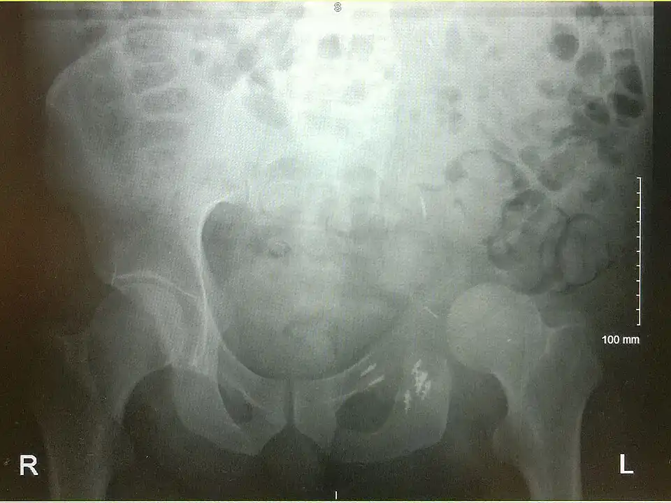 An x-ray of a limb-sparing hemipelvectomy on the left side of a male pelvis taken one month after surgery.