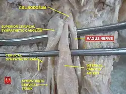 Vagus nerve – dissection