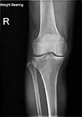 Knee X-ray (weight bearing)