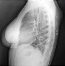 X-ray showing lipoma