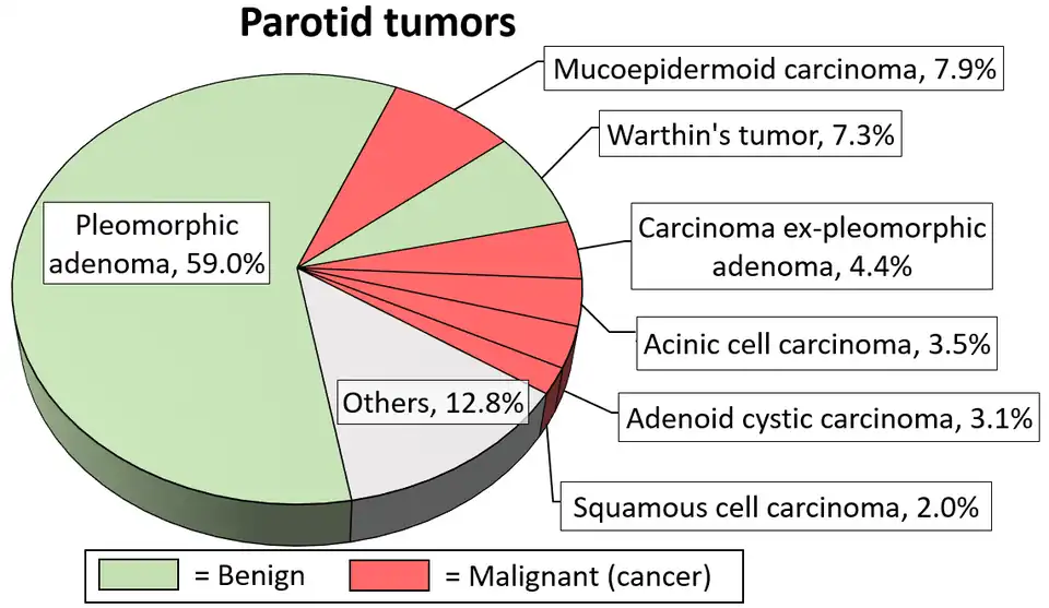 Relative incidence of parotid tumors, showing mucoepidermoid carcinoma at top right.[15]