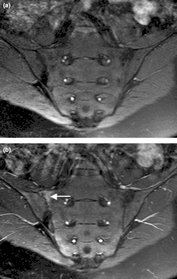 T1-weighted semi-coronal MRI of sacroiliac joints (a) before and (b) after contrast showing active sacroiliitis (arrow).