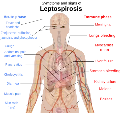A schematic of the human body showing the symptoms and signs of leptospirosis