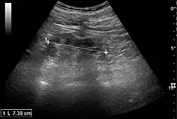 Chronic pyelonephritis with reduced kidney size and focal cortical thinning. Measurement of kidney length on the US image is illustrated by '+' and a dashed line.[63]
