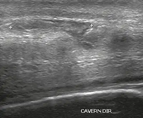 Figure 4 A: Ultrasound of the penis, right lateral view. Longitudinal section showing rupture of the tunica albuginea with an adjacent 1.92 cm hematoma (between calipers), due to trauma.[2]
