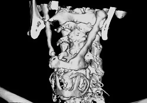 3D-reconstructed CT scan showing bilateral stylohyoid ligament ossification