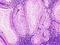 Histopathology of Warthin tumor in the parotid gland. Another view of a file "Warthin tumor (1).jpg". H&E stain.